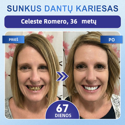 GarageLine®🦷 „Tideglusib“ dantų ir dantenų „NanoRepair“ tirpios balinančios juostelės ✨ (Padeda atkurti dantų audinius ir sumažinti dantenų diskomfortą bei kitas dažnas burnos ertmės problemas)