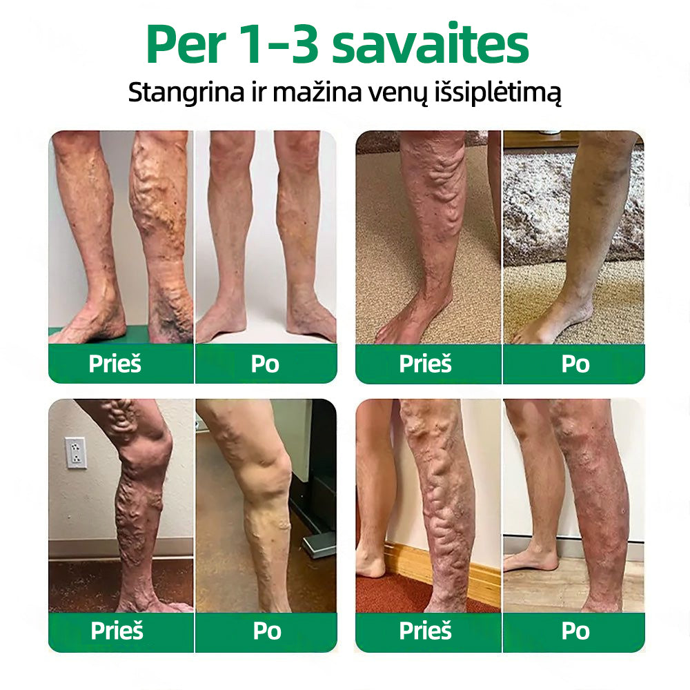 🇱🇹👨‍⚕️✅Healrize® VeinTarget mikroadatų pleistras⚡Nedelsiant palengvėja, ilgalaikiai rezultatai🪗