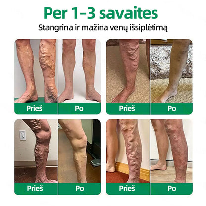🇱🇹👨‍⚕️✅Healrize® VeinTarget mikroadatų pleistras⚡Nedelsiant palengvėja, ilgalaikiai rezultatai🪗
